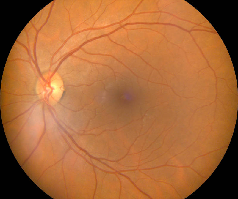 Fundus image 2